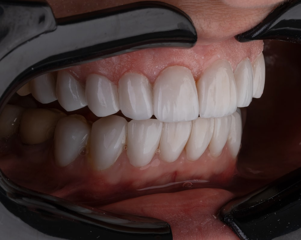 Why Over-The-Counter Dental Guards Cause Gum Swelling!